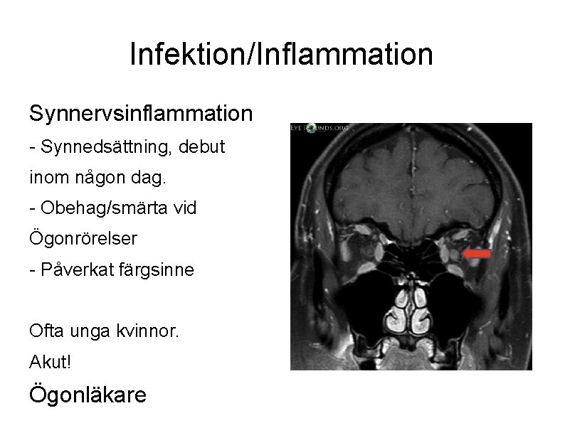 Infektion/Inflammation Synnervsinflammation - Synnedsättning, debut inom någon dag. - Obehag/smärta vid Ögonrörelser - Påverkat