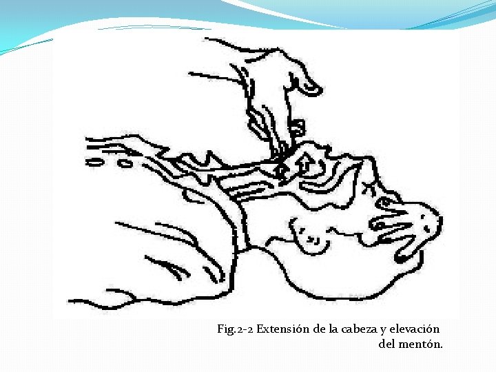 Fig. 2 -2 Extensión de la cabeza y elevación del mentón. 