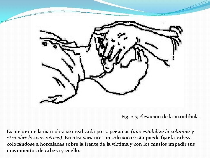 Fig. 2 -3 Elevación de la mandíbula. Es mejor que la maniobra sea realizada