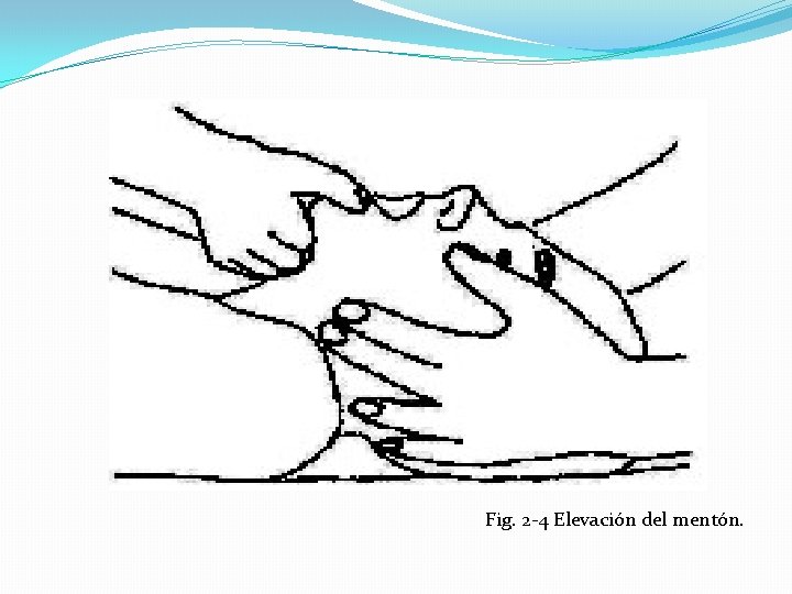Fig. 2 -4 Elevación del mentón. 