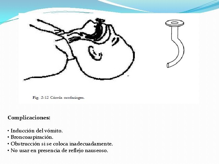 Complicaciones: • Inducción del vómito. • Broncoaspiración. • Obstrucción si se coloca inadecuadamente. •