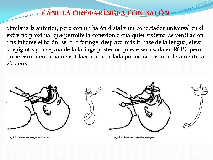 CÁNULA OROFARÍNGEA CON BALÓN Similar a la anterior, pero con un balón distal y