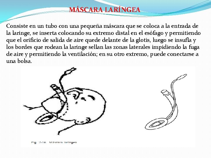 MÁSCARA LARÍNGEA Consiste en un tubo con una pequeña máscara que se coloca a