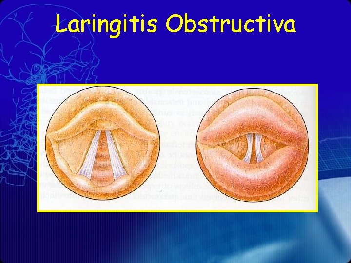 Laringitis Obstructiva 