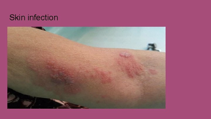 Skin infection 