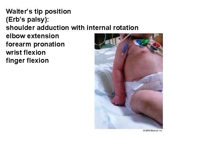 Waiter’s tip position (Erb’s palsy): shoulder adduction with internal rotation elbow extension forearm pronation