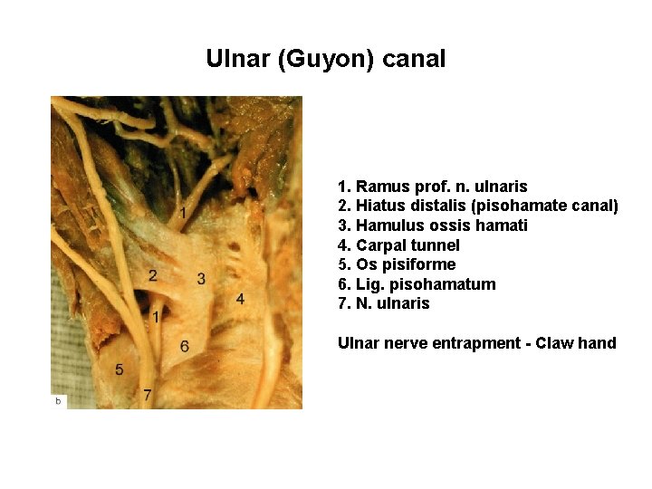 Ulnar (Guyon) canal 1. Ramus prof. n. ulnaris 2. Hiatus distalis (pisohamate canal) 3.