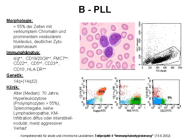 B - PLL Morphologie: > 55% der Zellen mit verklumptem Chromatin und prominentem vesikulärem