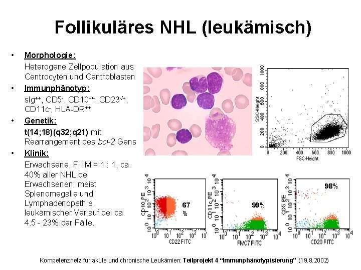 Follikuläres NHL (leukämisch) • • Morphologie: Heterogene Zellpopulation aus Centrocyten und Centroblasten Immunphänotyp: s.