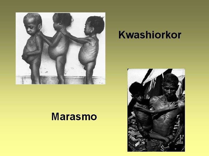 Kwashiorkor Marasmo 