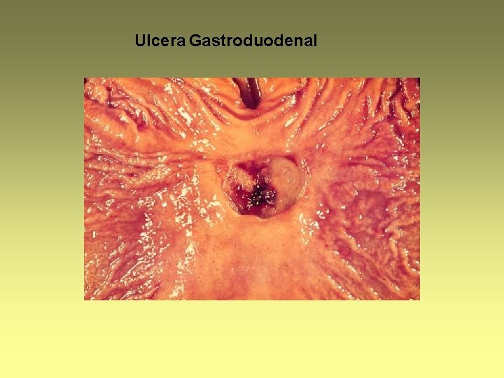 Ulcera Gastroduodenal 