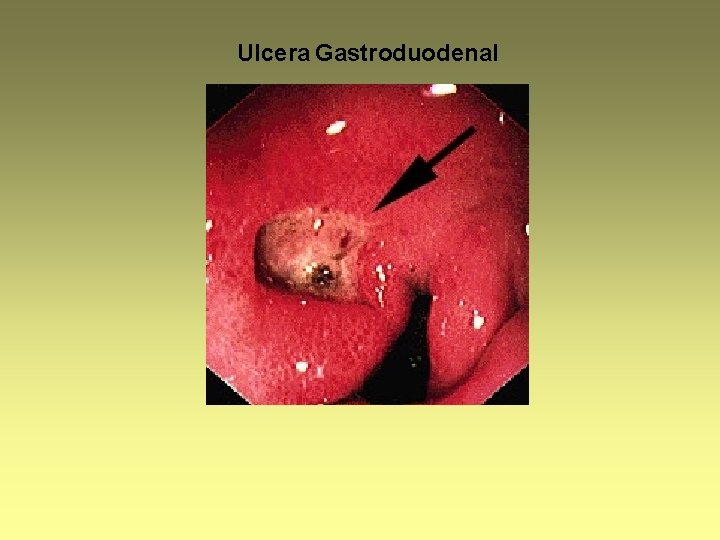 Ulcera Gastroduodenal 