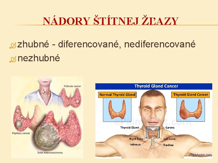 NÁDORY ŠTÍTNEJ ŽĽAZY zhubné - diferencované, nediferencované nezhubné 