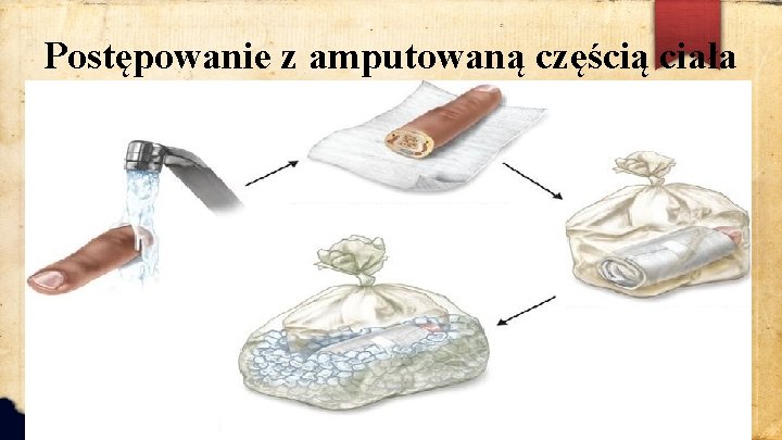 Postępowanie z amputowaną częścią ciała 