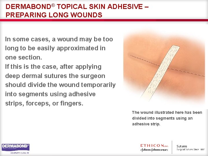 Month 20 TOPICAL SKIN ADHESIVES DERMABOND Topical Skin