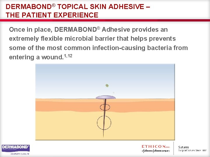 DERMABOND® TOPICAL SKIN ADHESIVE – THE PATIENT EXPERIENCE Once in place, DERMABOND® Adhesive provides