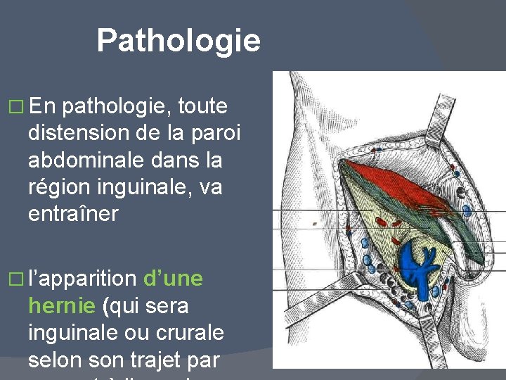 Pathologie � En pathologie, toute distension de la paroi abdominale dans la région inguinale,