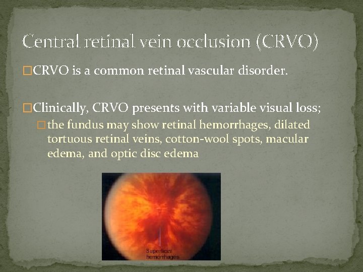 Central retinal vein occlusion (CRVO) �CRVO is a common retinal vascular disorder. �Clinically, CRVO