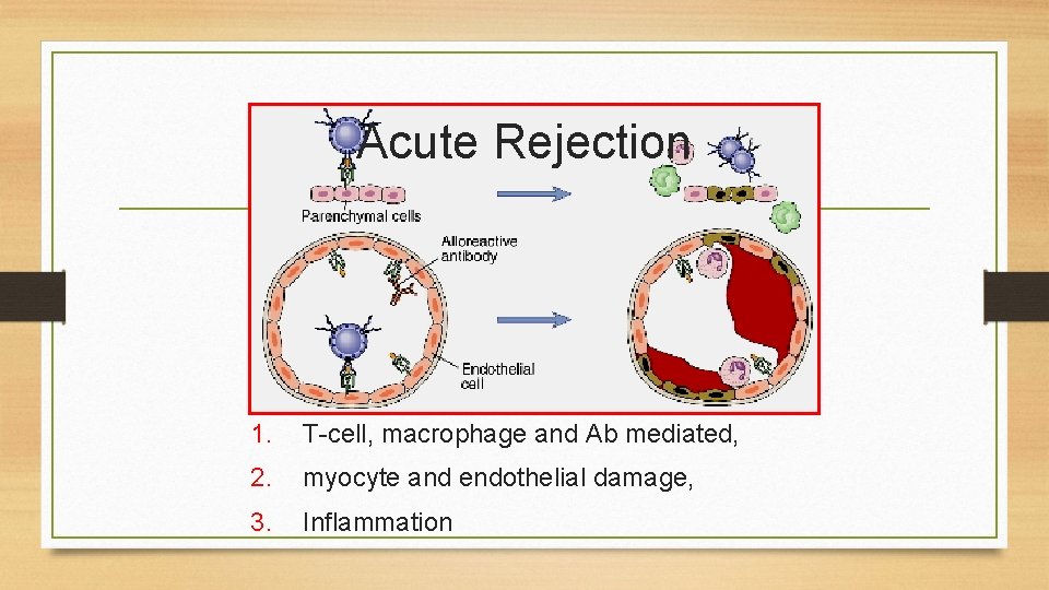 Acute Rejection 1. T-cell, macrophage and Ab mediated, 2. myocyte and endothelial damage, 3.