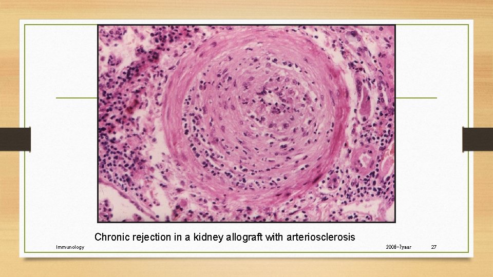 Chronic rejection in a kidney allograft with arteriosclerosis Immunology 2006 -7 year 27 