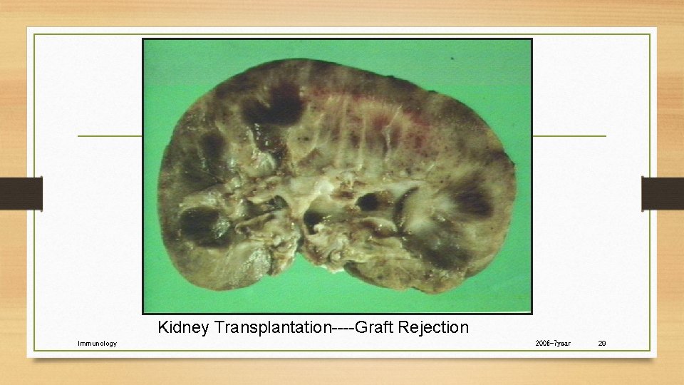 Kidney Transplantation----Graft Rejection Immunology 2006 -7 year 29 