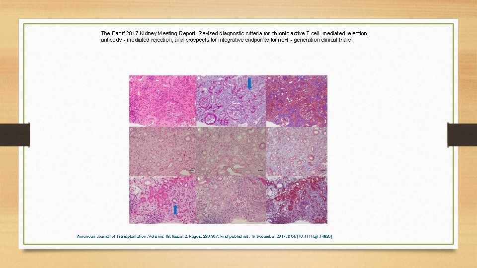 The Banff 2017 Kidney Meeting Report: Revised diagnostic criteria for chronic active T cell–mediated