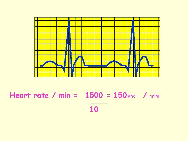 Heart rate / min = 1500 = 150ครง / นาท 10 