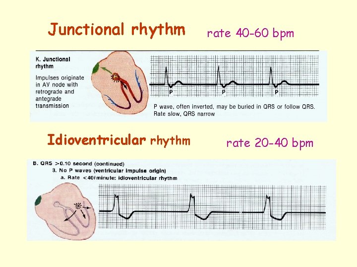 Junctional rhythm Idioventricular rhythm rate 40 -60 bpm rate 20 -40 bpm 