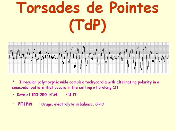 Torsades de Pointes (Td. P) • Irregular polymorphic wide complex tachycardia with alternating polarity