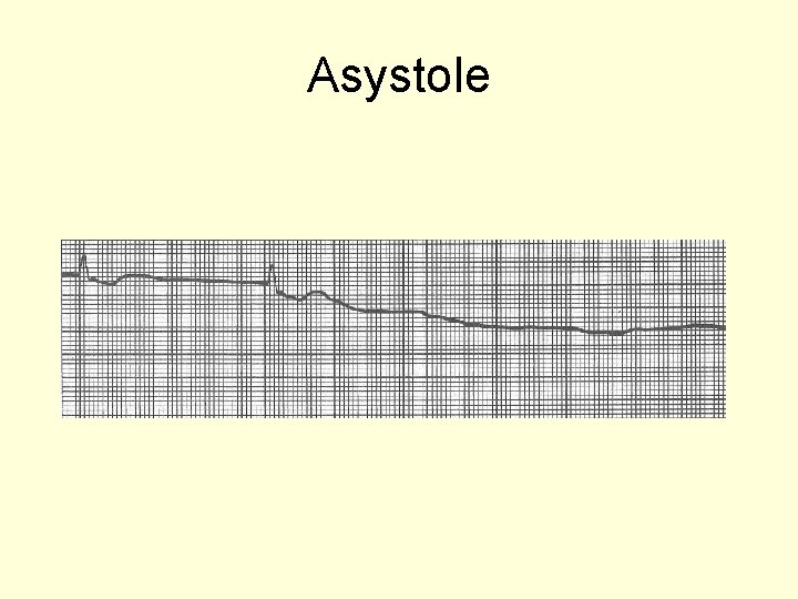 Asystole 
