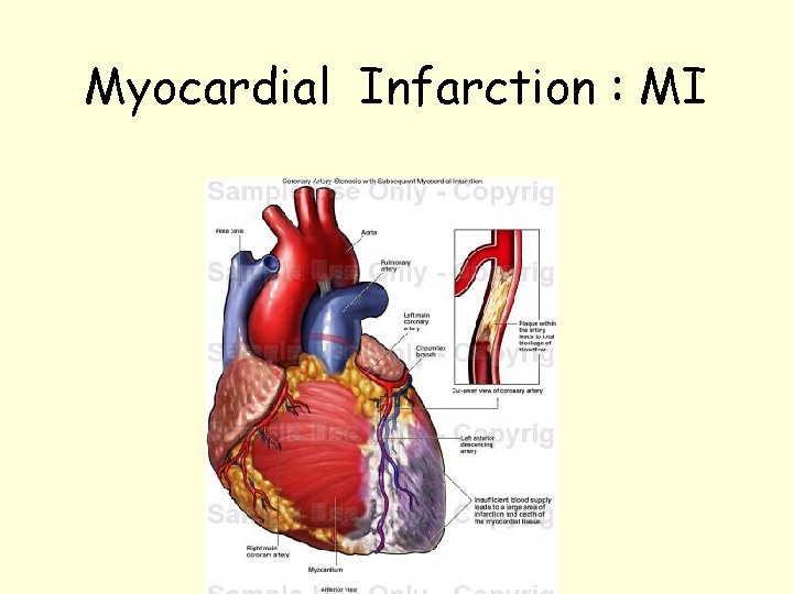 Myocardial Infarction : MI 