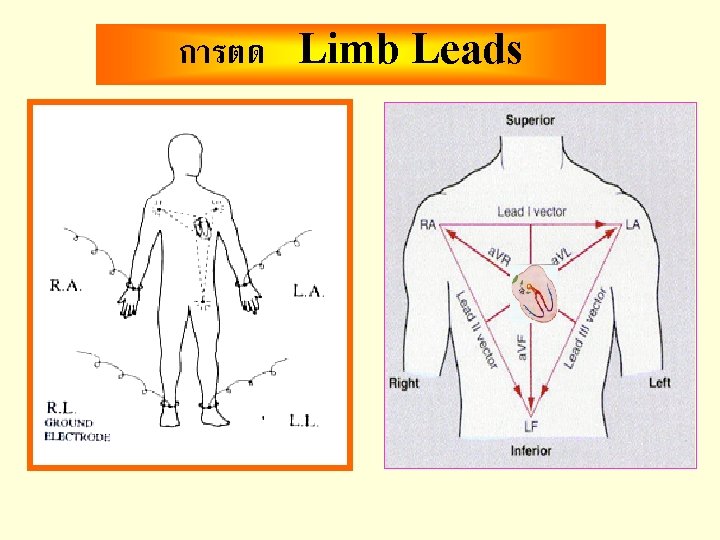 การตด Limb Leads 