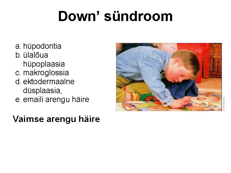 Down’ sündroom a. hüpodontia b. ülalõua hüpoplaasia c. makroglossia d. ektodermaalne düsplaasia, e. emaili