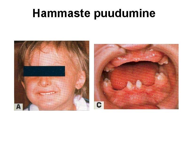 Hammaste puudumine 