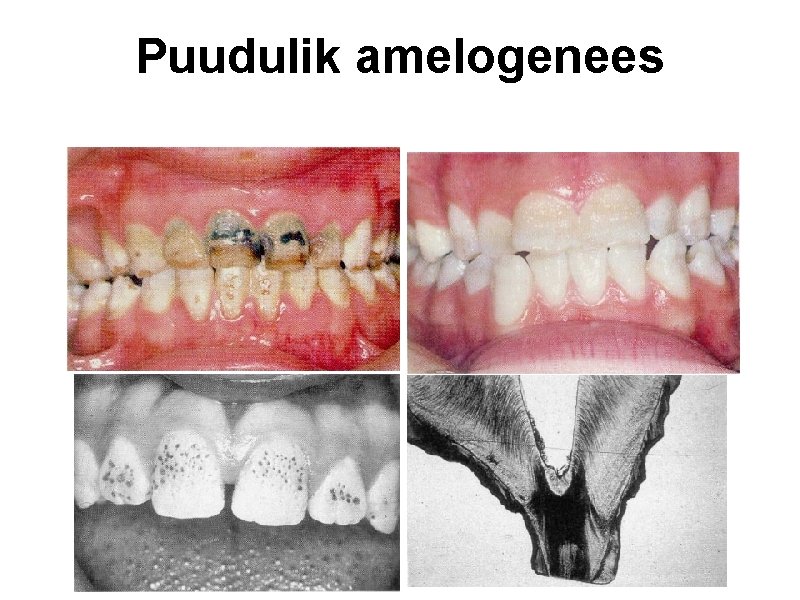 Puudulik amelogenees 