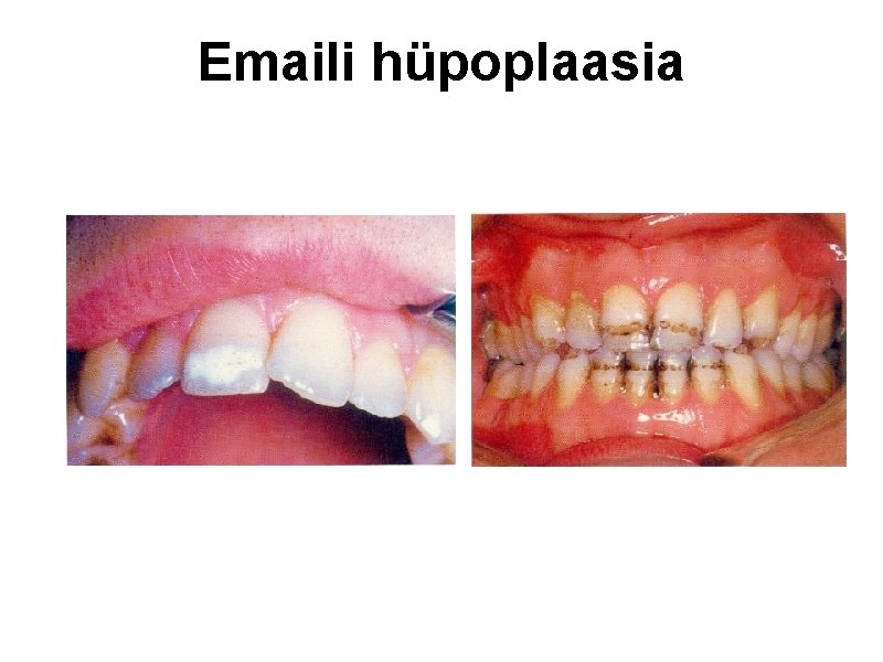 Emaili hüpoplaasia 