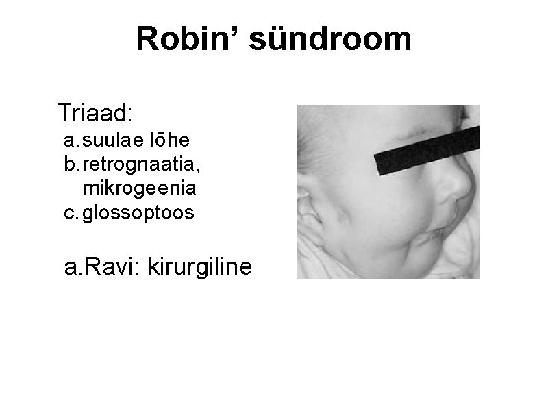 Robin’ sündroom Triaad: a. suulae lõhe b. retrognaatia, mikrogeenia c. glossoptoos a. Ravi: kirurgiline