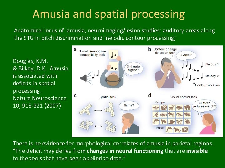Amusia and spatial processing Anatomical locus of amusia, neuroimaging/lesion studies: auditory areas along the