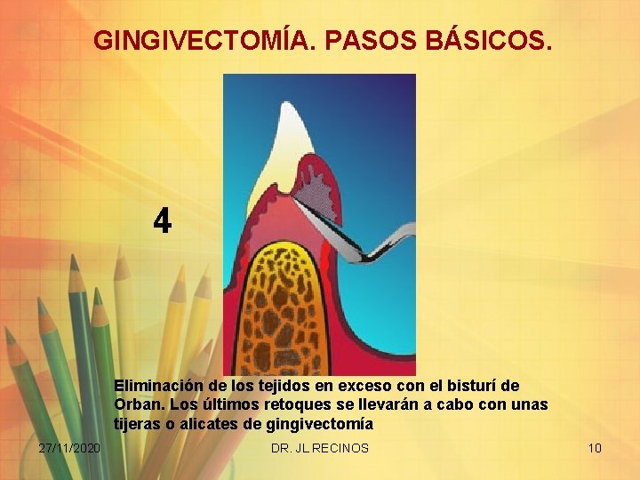 GINGIVECTOMÍA. PASOS BÁSICOS. 4 Eliminación de los tejidos en exceso con el bisturí de