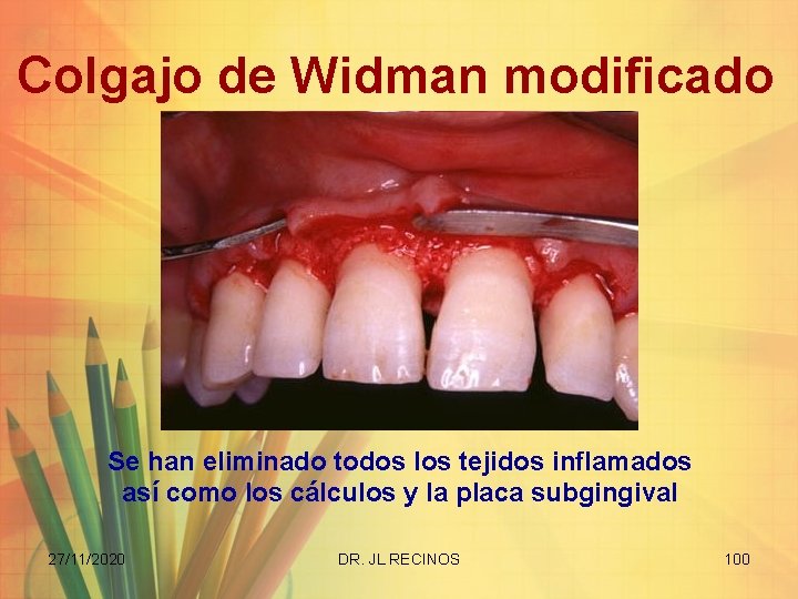 Colgajo de Widman modificado Se han eliminado todos los tejidos inflamados así como los