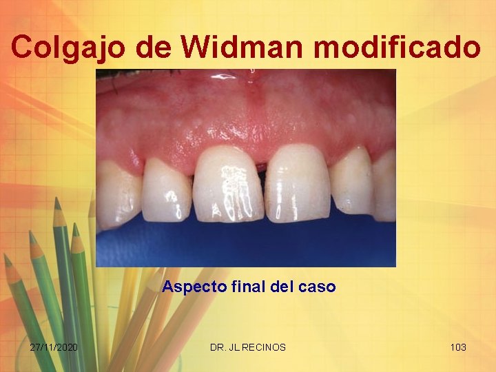 Colgajo de Widman modificado Aspecto final del caso 27/11/2020 DR. JL RECINOS 103 