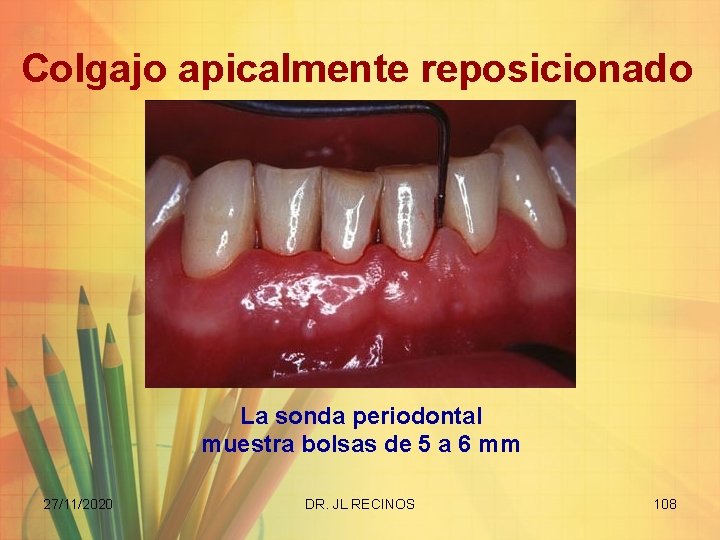 Colgajo apicalmente reposicionado La sonda periodontal muestra bolsas de 5 a 6 mm 27/11/2020