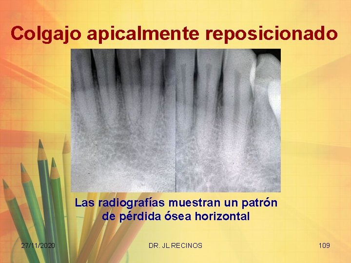 Colgajo apicalmente reposicionado Las radiografías muestran un patrón de pérdida ósea horizontal 27/11/2020 DR.