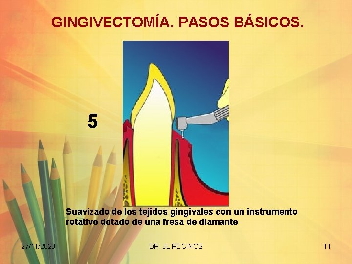 GINGIVECTOMÍA. PASOS BÁSICOS. 5 Suavizado de los tejidos gingivales con un instrumento rotativo dotado