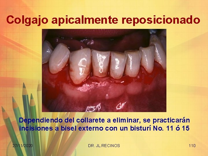 Colgajo apicalmente reposicionado Dependiendo del collarete a eliminar, se practicarán incisiones a bisel externo