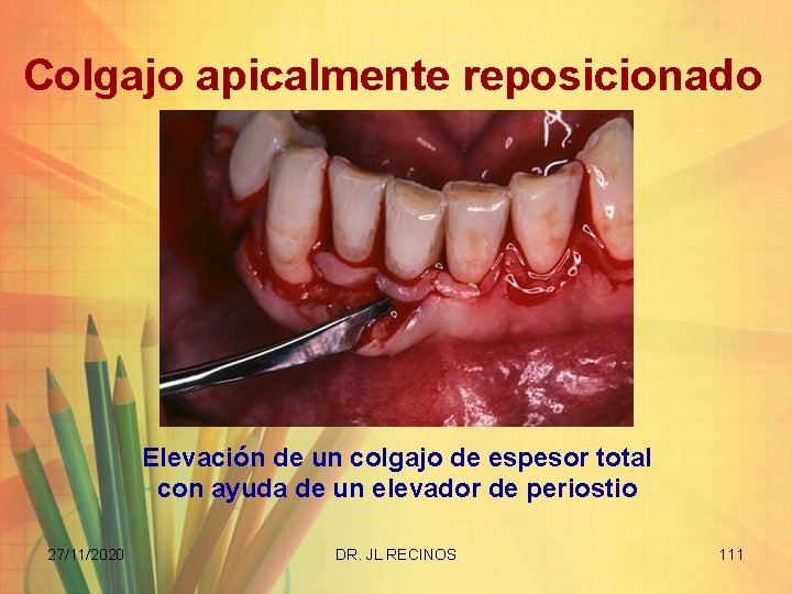 Colgajo apicalmente reposicionado Elevación de un colgajo de espesor total con ayuda de un