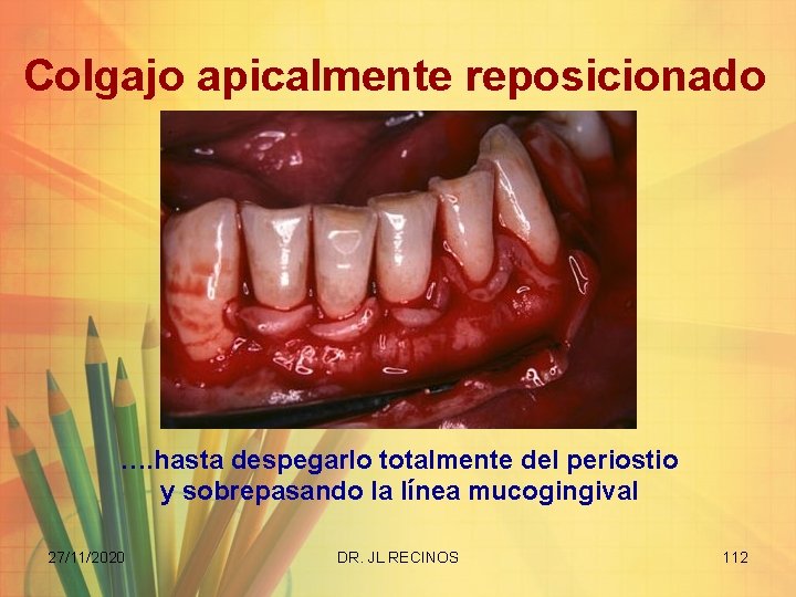 Colgajo apicalmente reposicionado …. hasta despegarlo totalmente del periostio y sobrepasando la línea mucogingival