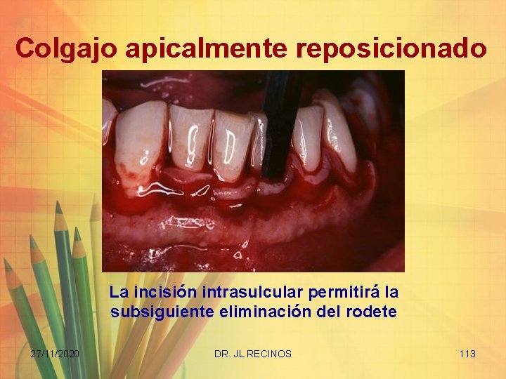 Colgajo apicalmente reposicionado La incisión intrasulcular permitirá la subsiguiente eliminación del rodete 27/11/2020 DR.