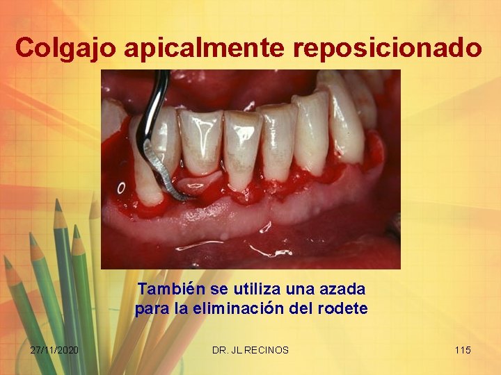 Colgajo apicalmente reposicionado También se utiliza una azada para la eliminación del rodete 27/11/2020