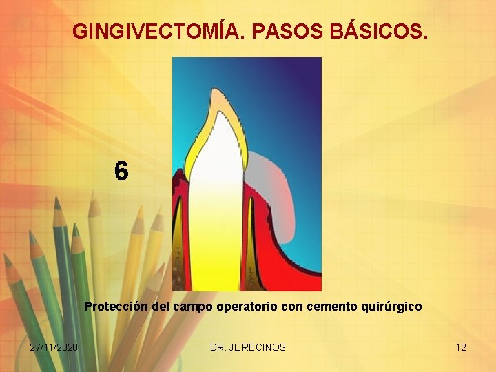 GINGIVECTOMÍA. PASOS BÁSICOS. 6 Protección del campo operatorio con cemento quirúrgico 27/11/2020 DR. JL